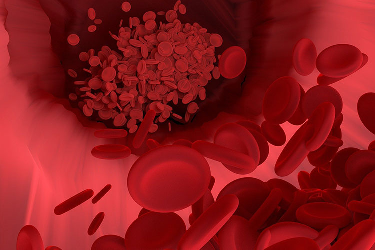 脂質異常症イメージ