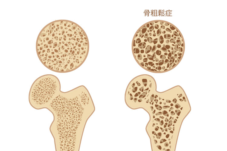 骨粗しょう症イメージ